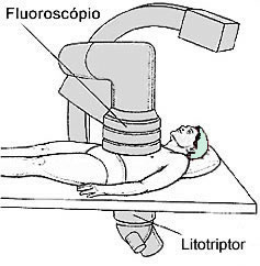 Litotripsia