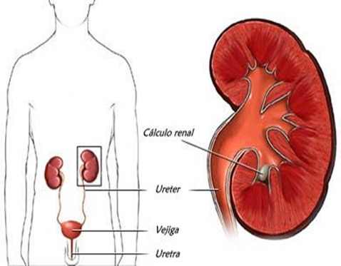 calculo renal - pedra no rim